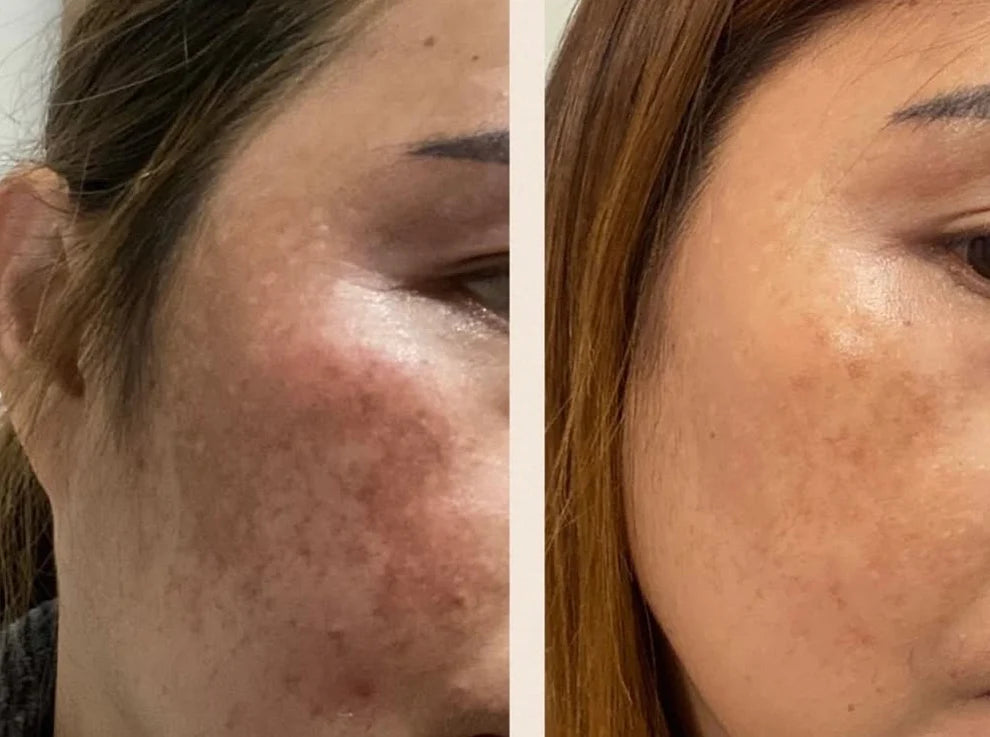 Dermaqual TRANEX PLUS pentru reducerea hiperpigmentării – Mezoterapie, 1x5ml